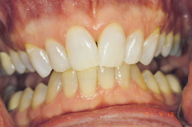 minocycline teeth discoloration treatment