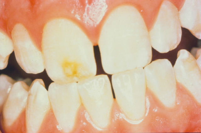 get rid yellow stained teeth