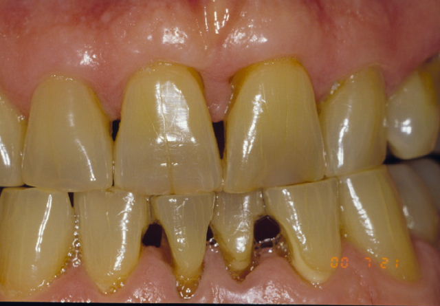 yellow teeth get rid of