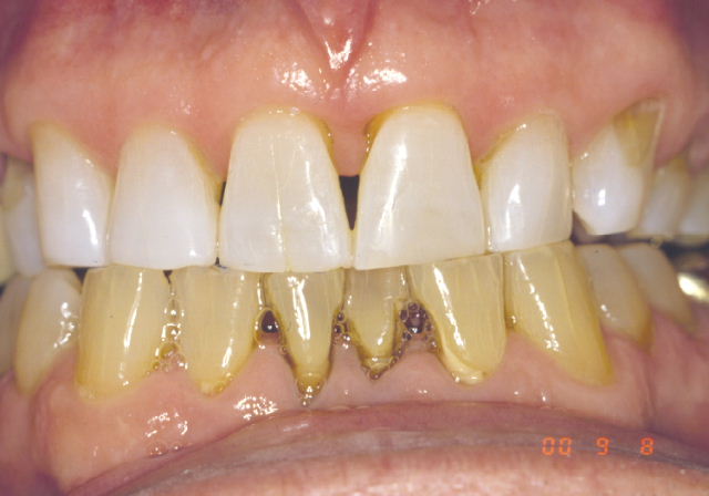 stop teeth discoloration