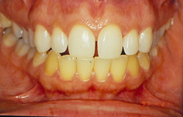 why are people born with yellow teeth